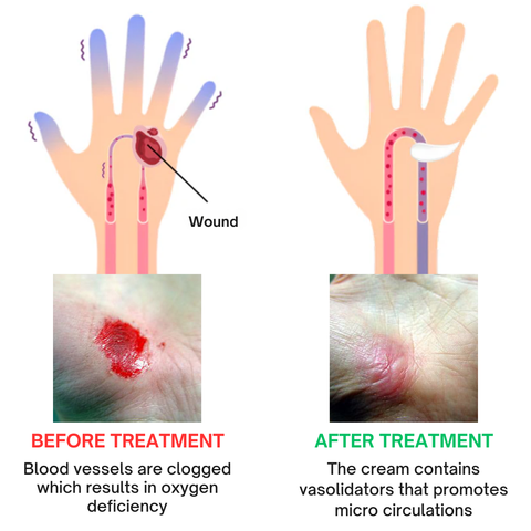 1+1 FREE | Glucomend™ - Cream for the treatment of diabetic wounds