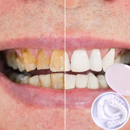 Snap-on Teeth™ - The Secret to a Hollywood Smile!